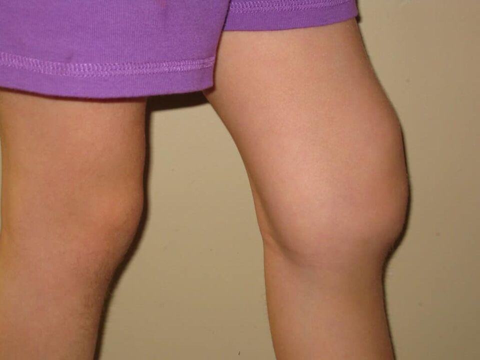 Patologija koljena s uznapredovalom artrozom