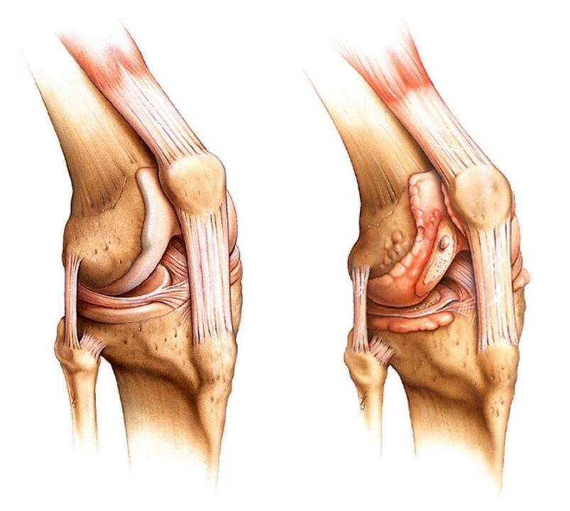 Zdrav zglob (lijevo) i artritičan zglob (desno)