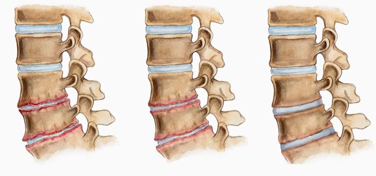 Deformacija intervertebralnih diskova kod osteohondroze može uzrokovati bol u leđima