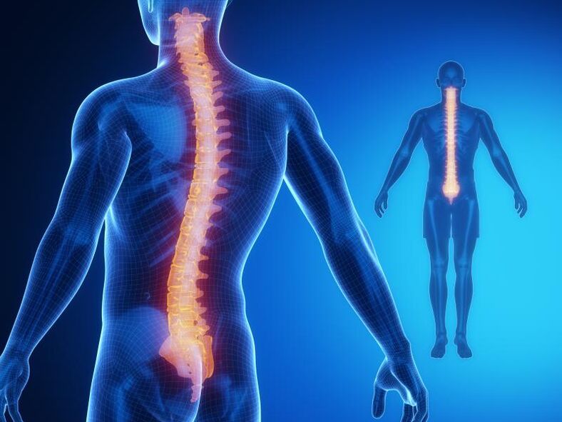 Osteokondroza kralježnice, koja zahtijeva složeno liječenje