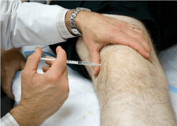 Intra -artikularna primjena analgetika kod jake boli